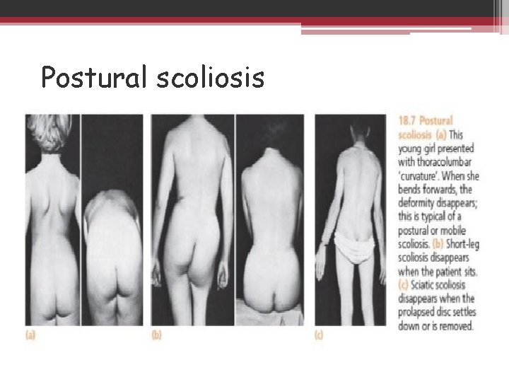 Postural scoliosis 