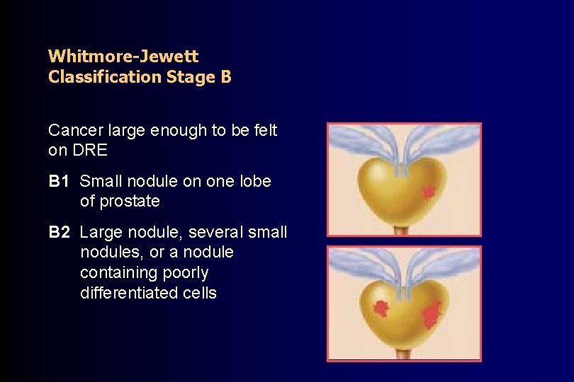 Whitmore-Jewett Classification Stage B Cancer large enough to be felt on DRE B 1