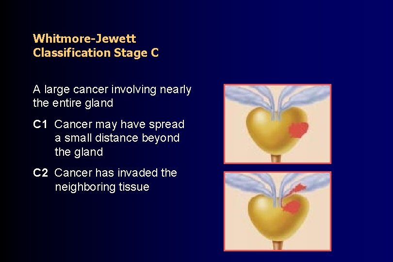 Whitmore-Jewett Classification Stage C A large cancer involving nearly the entire gland C 1