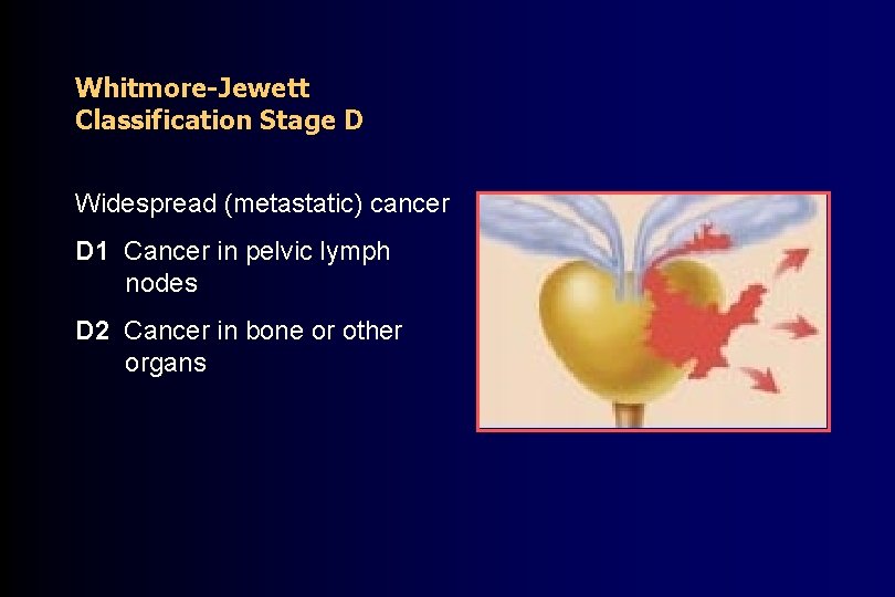 Whitmore-Jewett Classification Stage D Widespread (metastatic) cancer D 1 Cancer in pelvic lymph nodes