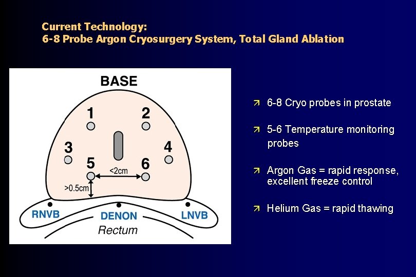 Current Technology: 6 -8 Probe Argon Cryosurgery System, Total Gland Ablation ä 6 -8