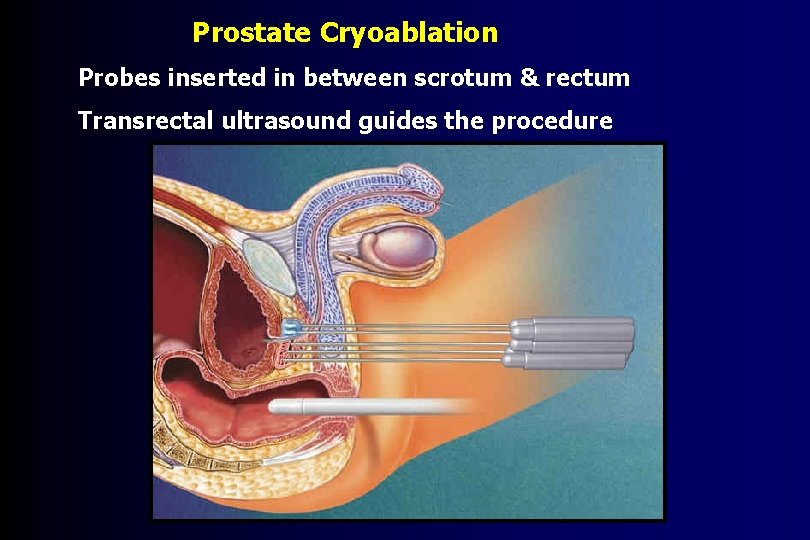 Prostate Cryoablation Probes inserted in between scrotum & rectum Transrectal ultrasound guides the procedure