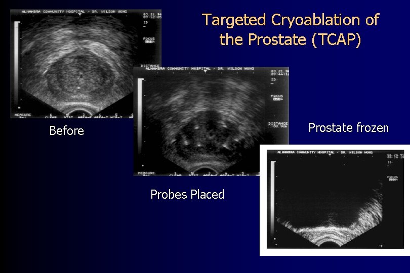 Targeted Cryoablation of the Prostate (TCAP) Prostate frozen Before Probes Placed 