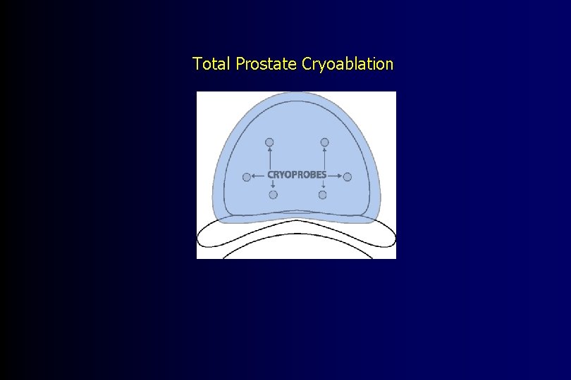 Total Prostate Cryoablation 