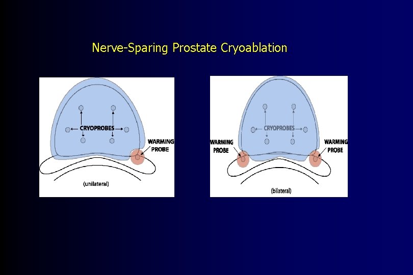 Nerve-Sparing Prostate Cryoablation 