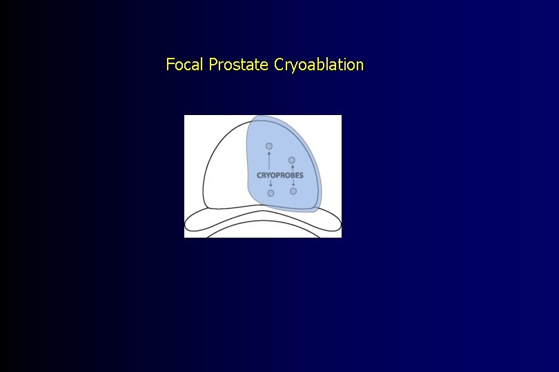 Focal Prostate Cryoablation 