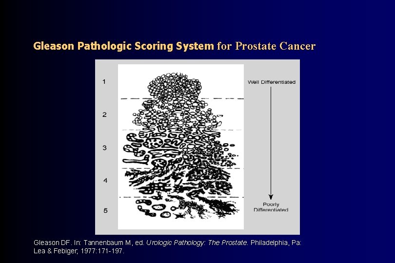 Gleason Pathologic Scoring System for Prostate Cancer Gleason DF. In: Tannenbaum M, ed. Urologic