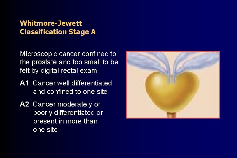 Whitmore-Jewett Classification Stage A Microscopic cancer confined to the prostate and too small to