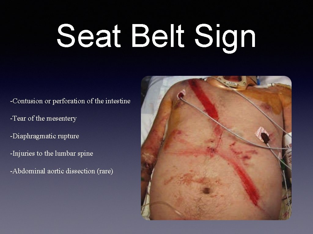 Seat Belt Sign -Contusion or perforation of the intestine -Tear of the mesentery -Diaphragmatic