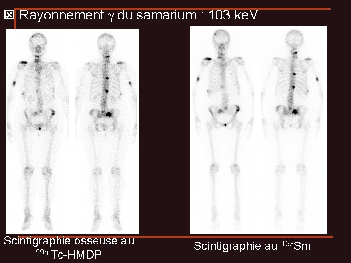  Rayonnement du samarium : 103 ke. V Scintigraphie osseuse au 99 m. Tc-HMDP