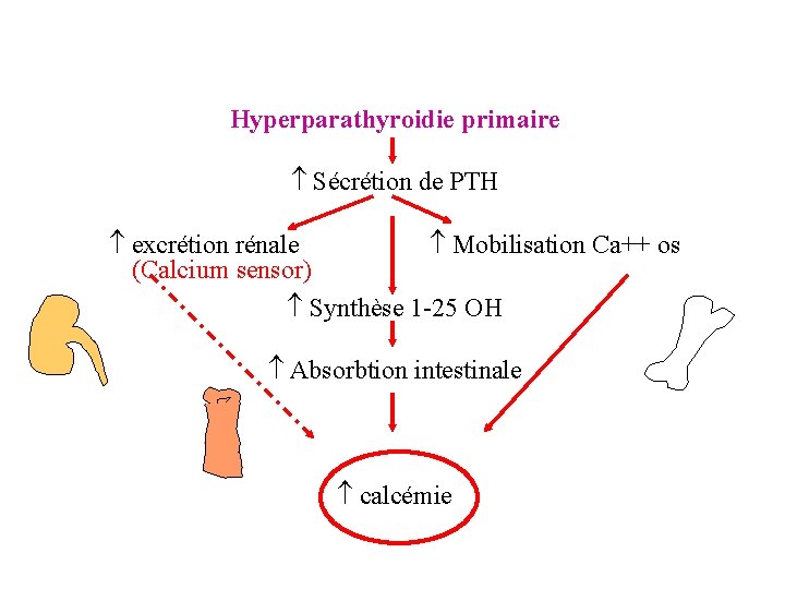 Hyperparathyroidie primaire Sécrétion de PTH excrétion rénale Mobilisation Ca++ os (Calcium sensor) Synthèse 1