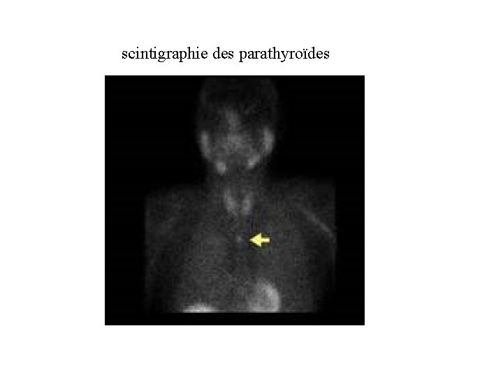 scintigraphie des parathyroïdes 