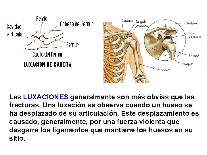 Las LUXACIONES generalmente son más obvias que las fracturas. Una luxación se observa cuando