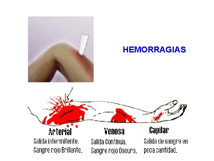  HEMORRAGIAS 