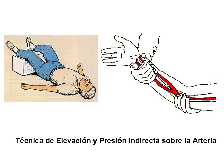  Técnica de Elevación y Presión Indirecta sobre la Arteria 