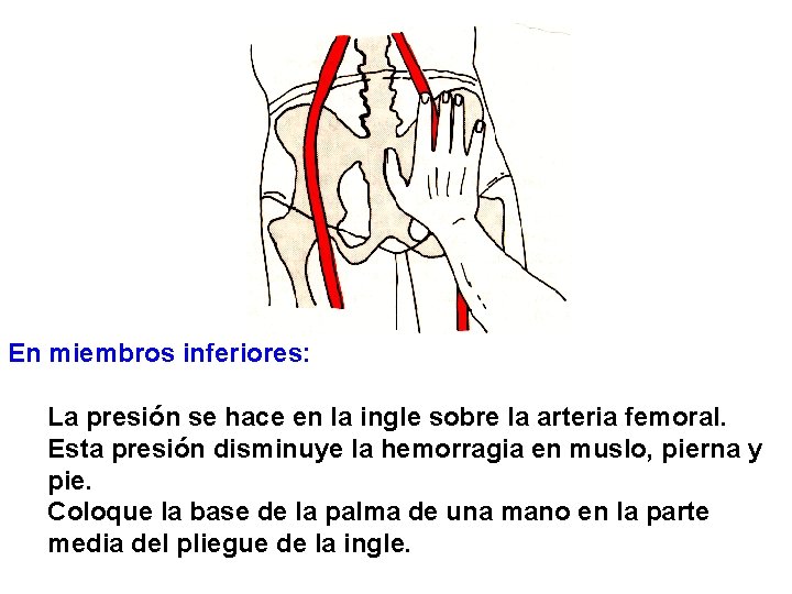 En miembros inferiores: La presión se hace en la ingle sobre la arteria femoral.