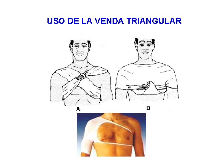 USO DE LA VENDA TRIANGULAR 