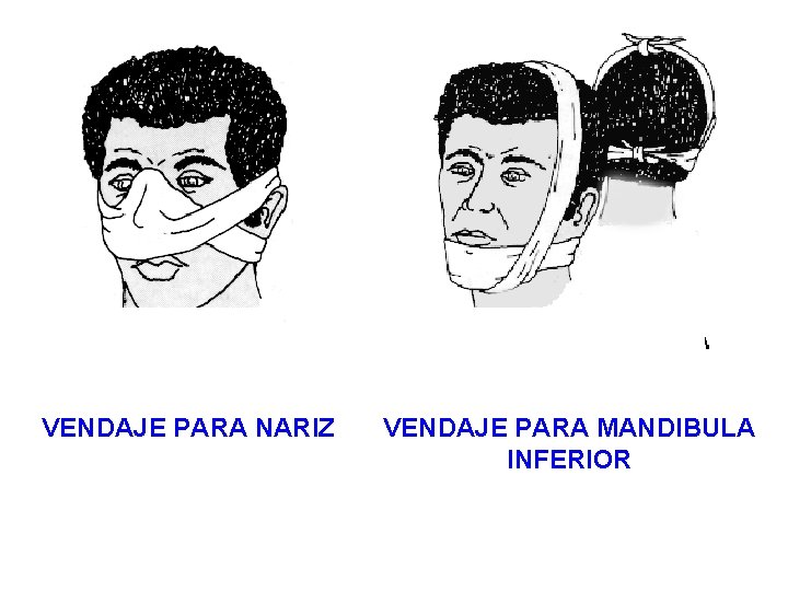 VENDAJE PARA NARIZ VENDAJE PARA MANDIBULA INFERIOR 