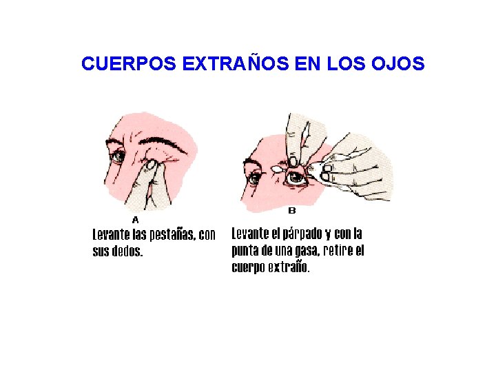 CUERPOS EXTRAÑOS EN LOS OJOS 