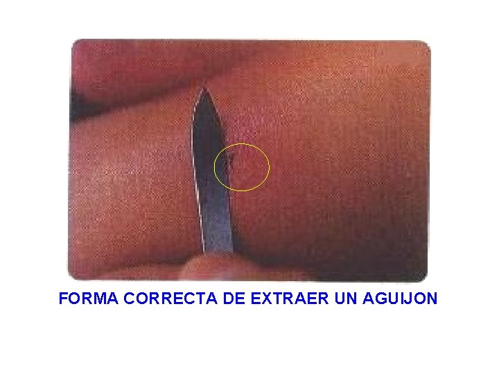 FORMA CORRECTA DE EXTRAER UN AGUIJON 