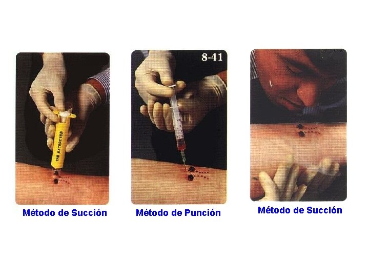 Método de Succión Método de Punción Método de Succión 