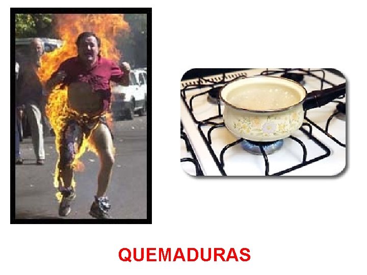 QUEMADURAS 