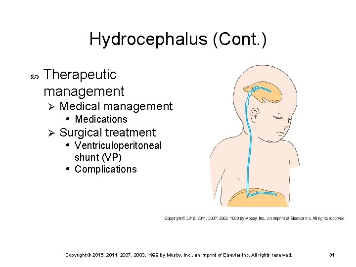 Hydrocephalus (Cont. ) Therapeutic management Medical management • Medications Ø Surgical treatment • Ventriculoperitoneal