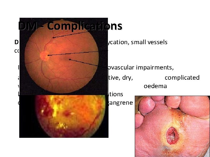 DM - Complications Diabetic retinopathy - protein glycation, small vessels collagenisation; microangiopathy Diabetic foot