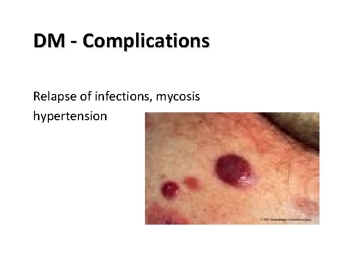 DM - Complications Relapse of infections, mycosis hypertension 
