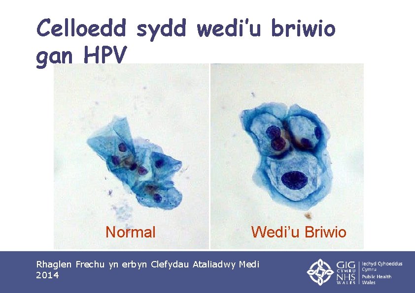 Celloedd sydd wedi’u briwio gan HPV Normal Wedi’u Briwio Rhaglen Frechu yn erbyn Clefydau
