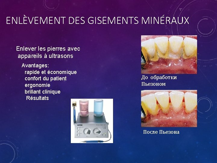 ENLÈVEMENT DES GISEMENTS MINÉRAUX Enlever les pierres avec appareils à ultrasons Avantages: rapide et