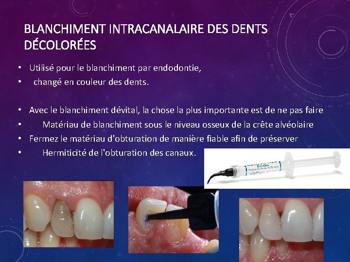 BLANCHIMENT INTRACANALAIRE DES DENTS DÉCOLORÉES • Utilisé pour le blanchiment par endodontie, • changé