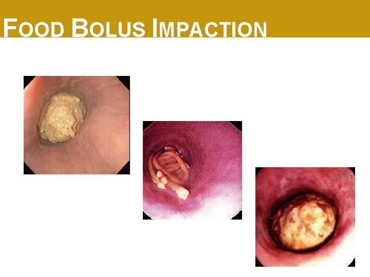 FOOD BOLUS IMPACTION 