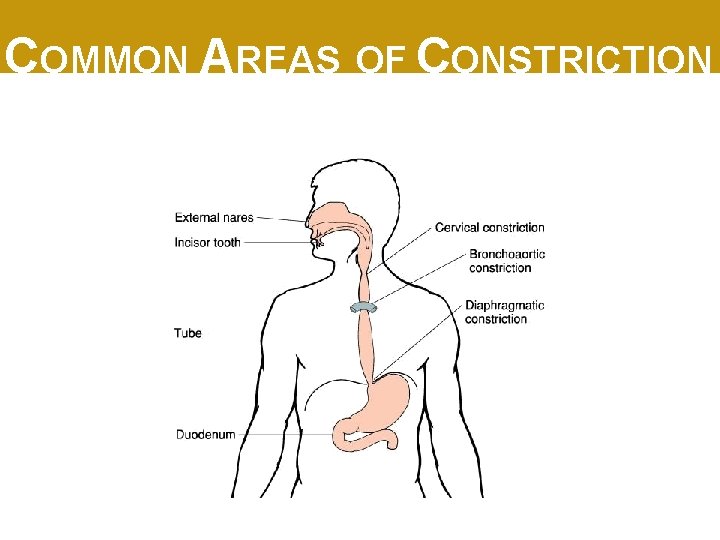 COMMON AREAS OF CONSTRICTION 