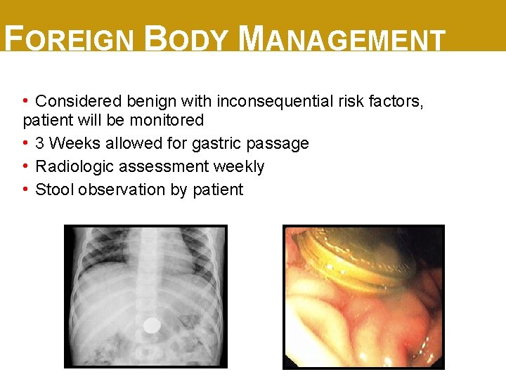 FOREIGN BODY MANAGEMENT • Considered benign with inconsequential risk factors, patient will be monitored