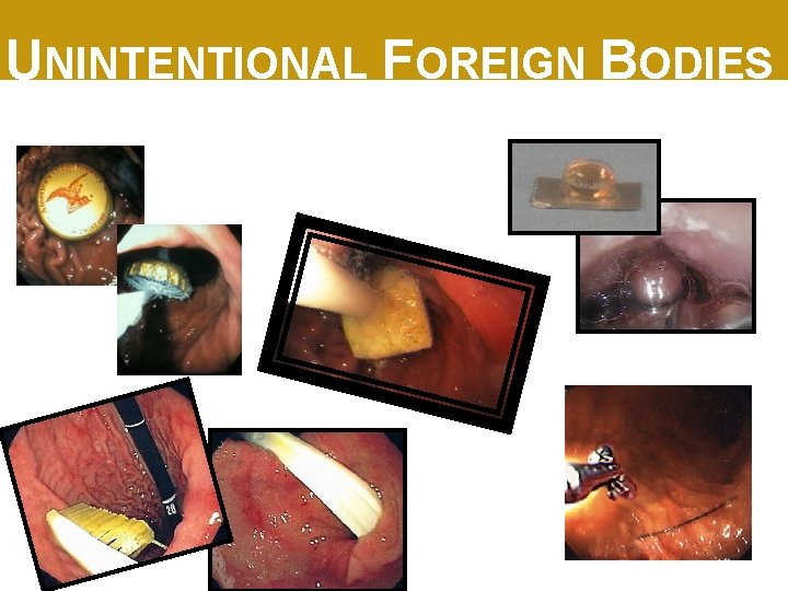 UNINTENTIONAL FOREIGN BODIES 
