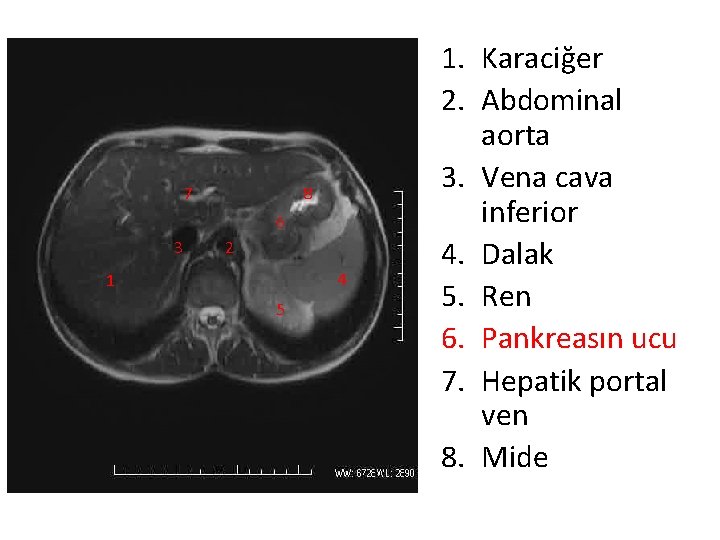 7 8 6 3 2 4 1 5 1. Karaciğer 2. Abdominal aorta 3.