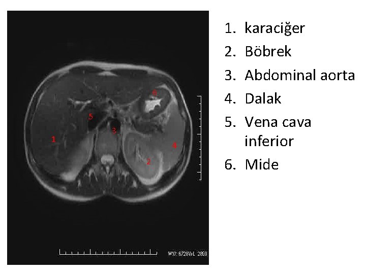 1. 2. 3. 4. 5. 6 5 1 3 4 2 karaciğer Böbrek Abdominal