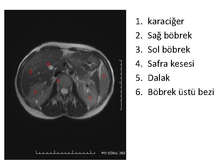 4 1 5 6 2 3 1. 2. 3. 4. 5. 6. karaciğer Sağ