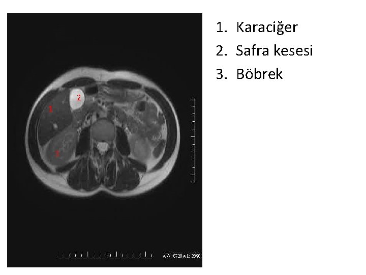 1. Karaciğer 2. Safra kesesi 3. Böbrek 2 1 3 