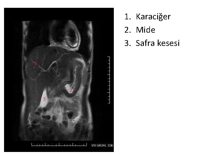 1. Karaciğer 2. Mide 3. Safra kesesi 1 2 3 