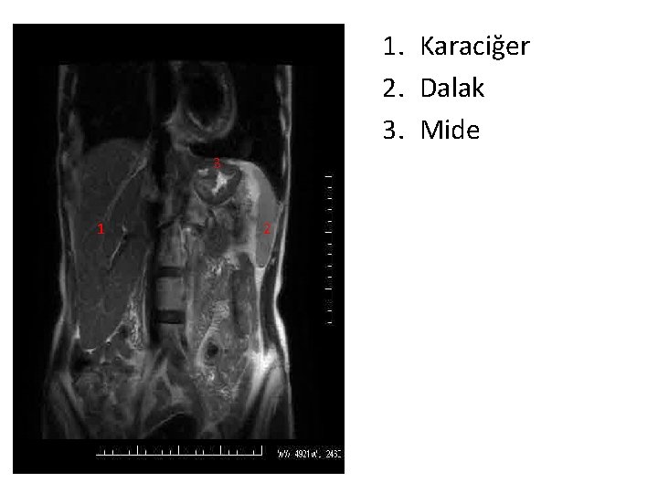 1. Karaciğer 2. Dalak 3. Mide 3 1 2 