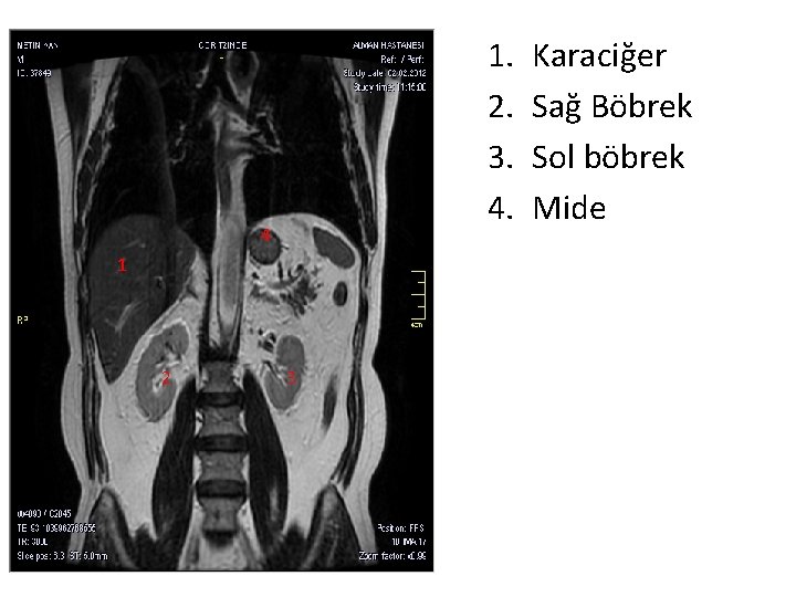 1. 2. 3. 4. 4 1 2 3 Karaciğer Sağ Böbrek Sol böbrek Mide