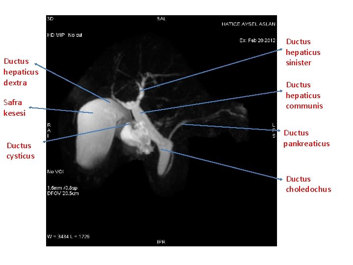 Ductus hepaticus dextra Safra kesesi Ductus cysticus Ductus hepaticus sinister Ductus hepaticus communis Ductus