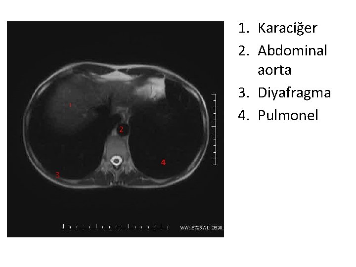 1. Karaciğer 2. Abdominal aorta 3. Diyafragma 4. Pulmonel 1 2 4 3 