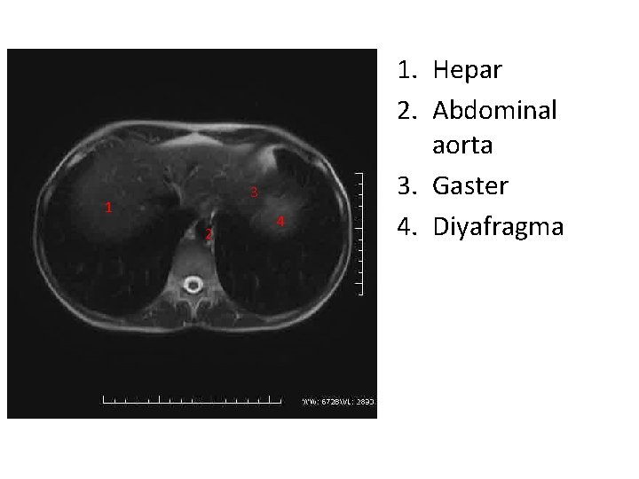 3 1 2 4 1. Hepar 2. Abdominal aorta 3. Gaster 4. Diyafragma 