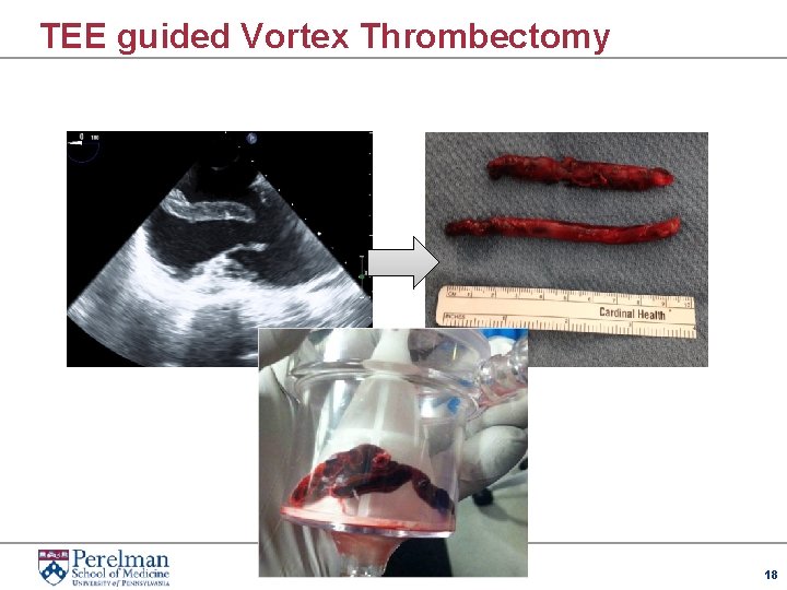 TEE guided Vortex Thrombectomy 18 