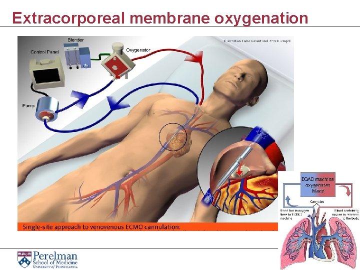 Extracorporeal membrane oxygenation 19 