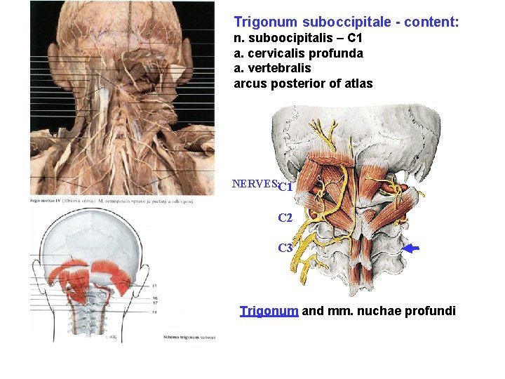 Trigonum suboccipitale - content: n. suboocipitalis – C 1 a. cervicalis profunda a. vertebralis