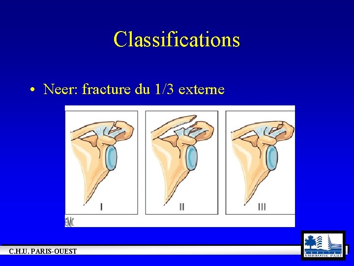 Classifications • Neer: fracture du 1/3 externe C. H. U. PARIS-OUEST 